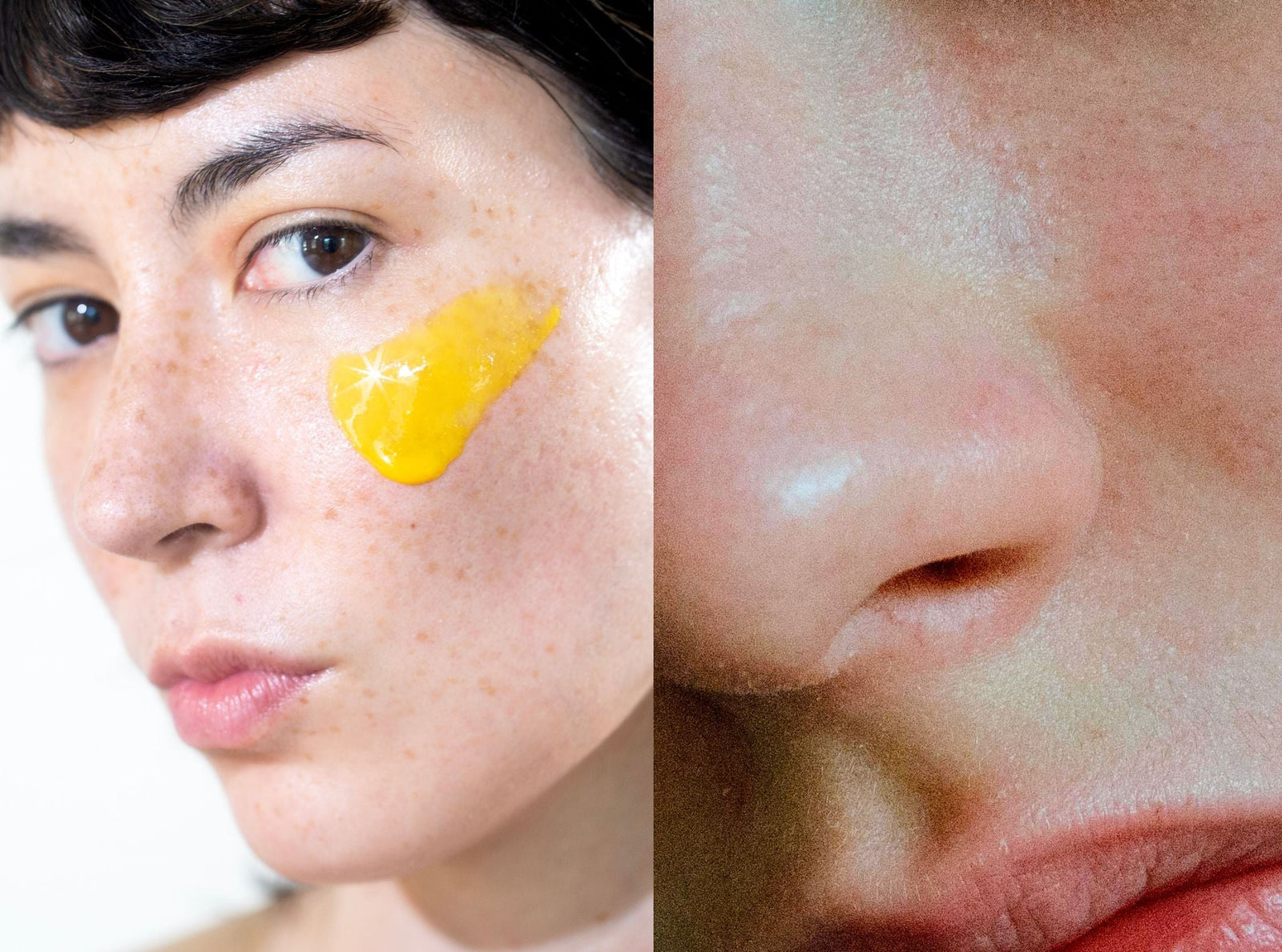 retinol for rosacea