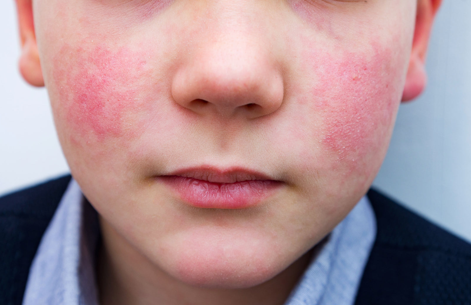 Close-up of a boy with irritated skin